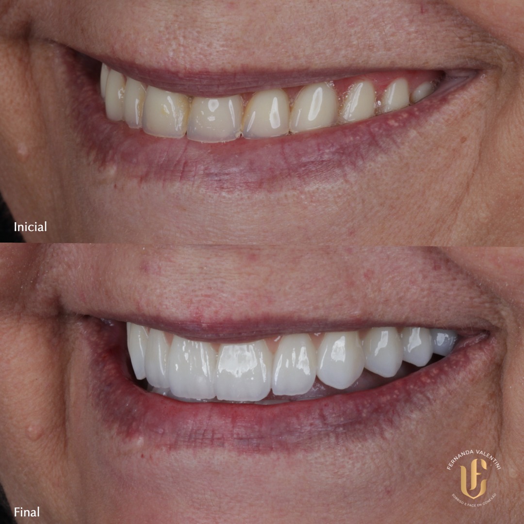 Lentes de Contato Cerâmicas